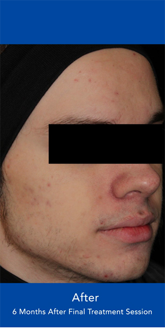 AviClear Before & After Patient #1668